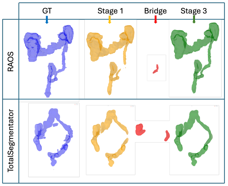 Colon segmentations from TotalSegmentator and RAOS showing reconnection across pipeline stages alongside ground truth.
